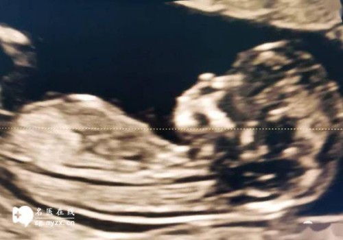 深圳助孕公司：试管婴儿适应人群有很多,糖尿病也能助孕成功