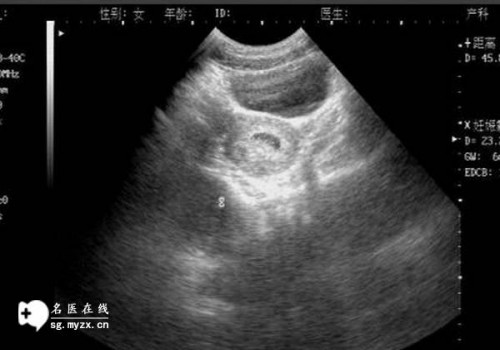 深圳试管婴儿价格：会在怀孕20周检查哪些？需要提前禁食吗