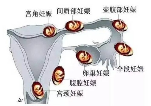 深圳试管助孕价格：死精症和无精症是不同的病症，你知道吗？
